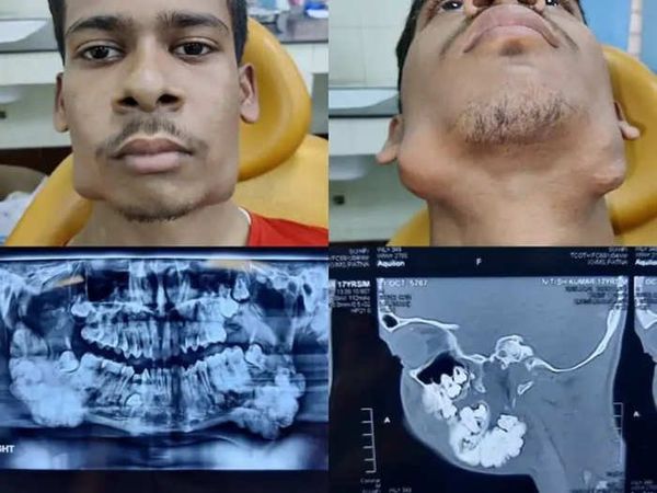 Viral News: दुर्लभ ट्यूमर वाले बिहार के किशोर के जबड़े से निकाले गए 82 दांत