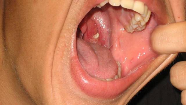 Tonsils There is a lump of flesh on both sides of the food passage of the throat, which we call tonsils. The inflammation arising in these is called tonsillitis / tonsils.